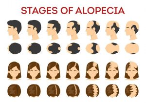 Stages of Alopecia