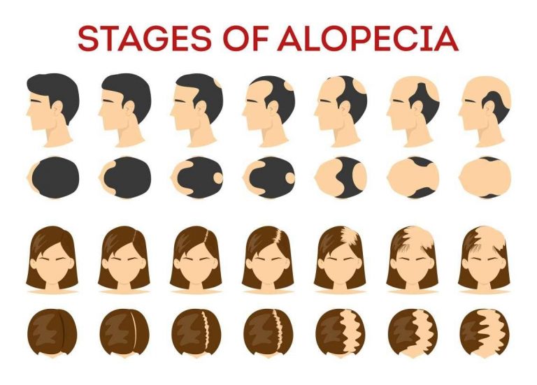 stages-of-alopecia-healthgardeners