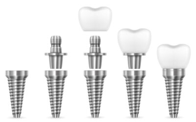 Dental Implants in Albania