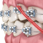 Cantilever Bridge Dentalis: Everything You Need to Know