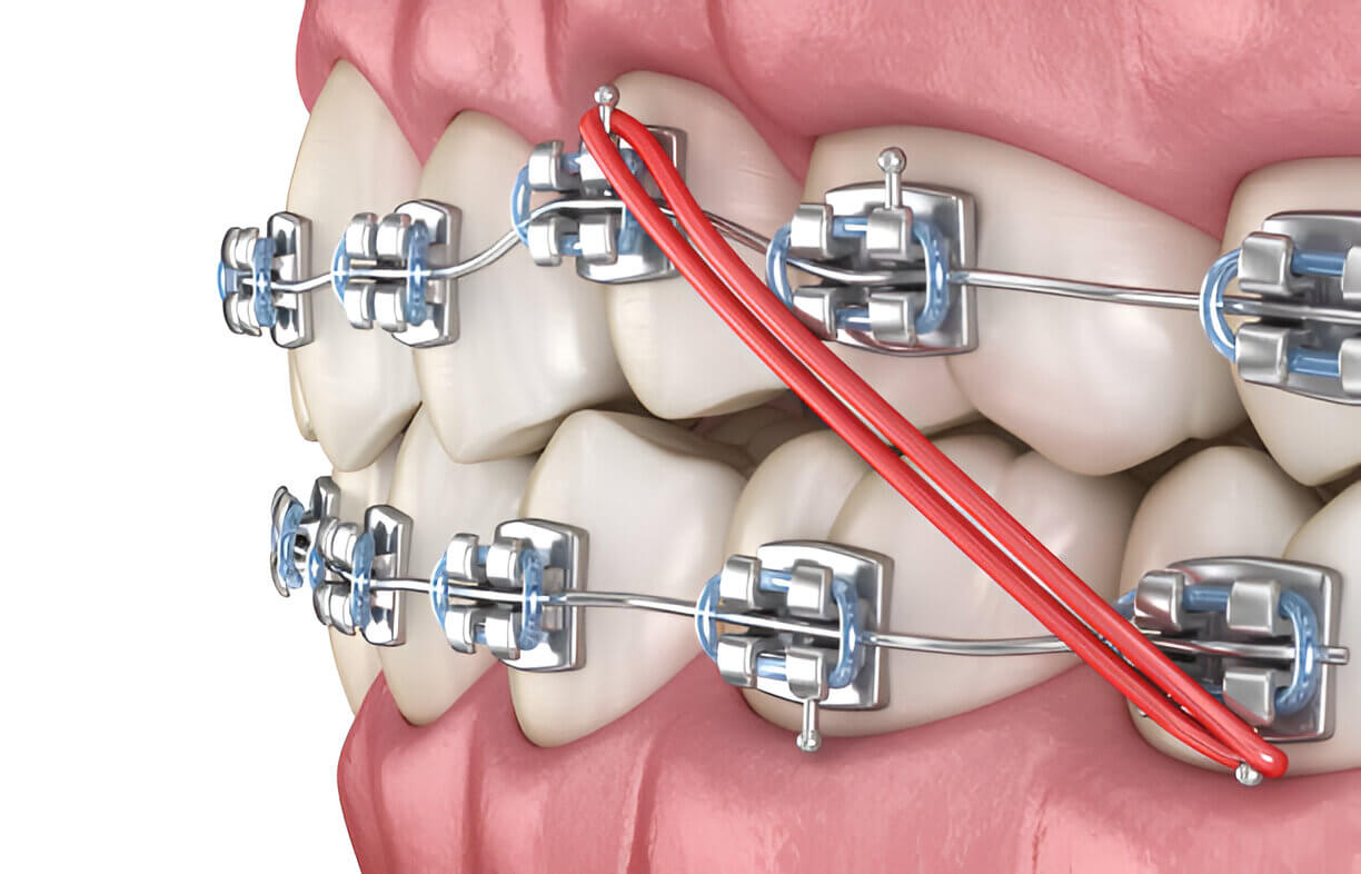 Cantilever Bridge Dentalis