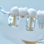 Benefits and Uses of Titanium Teeth in Dentistry