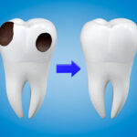 How to Get Food Out of a Wisdom Tooth Hole: Expert Tips for Effective Cleaning