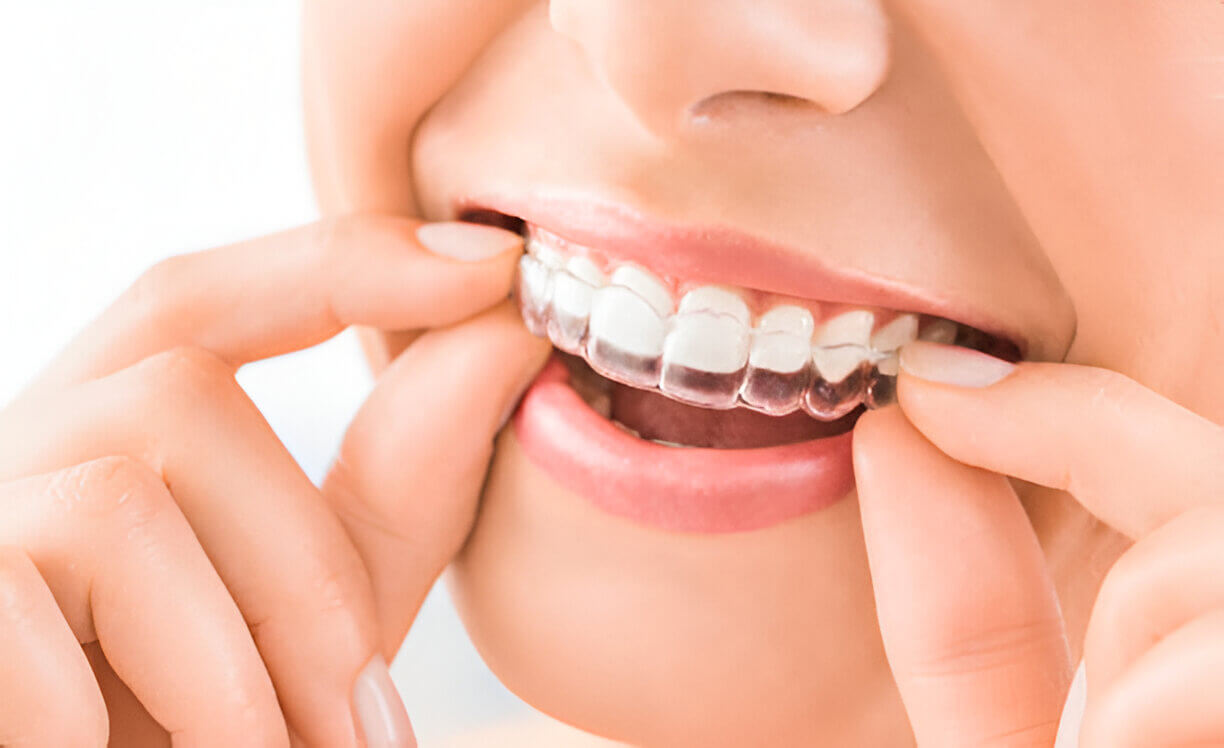 Aligner Care