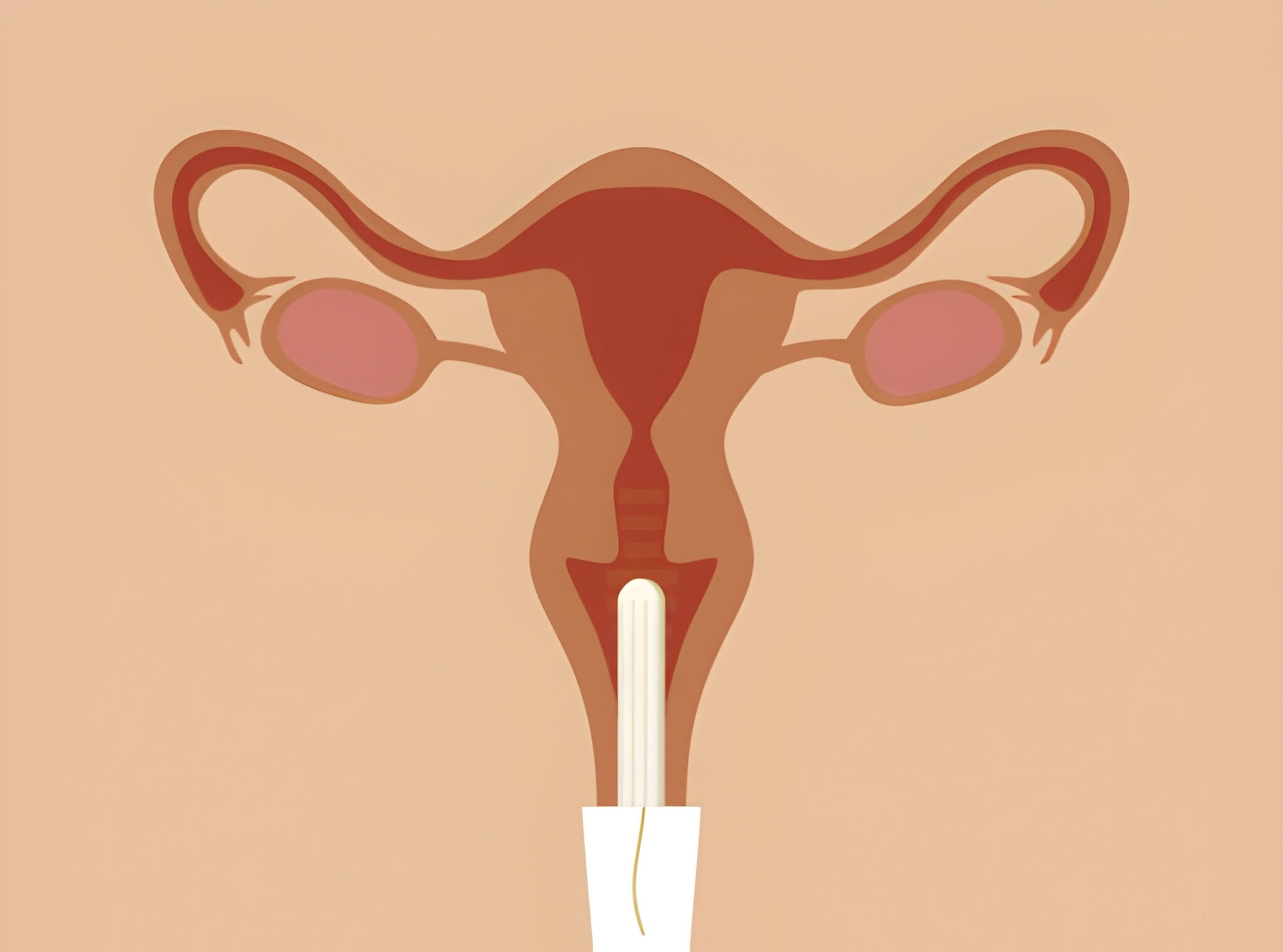 Brown Discharge After IUD Insertion