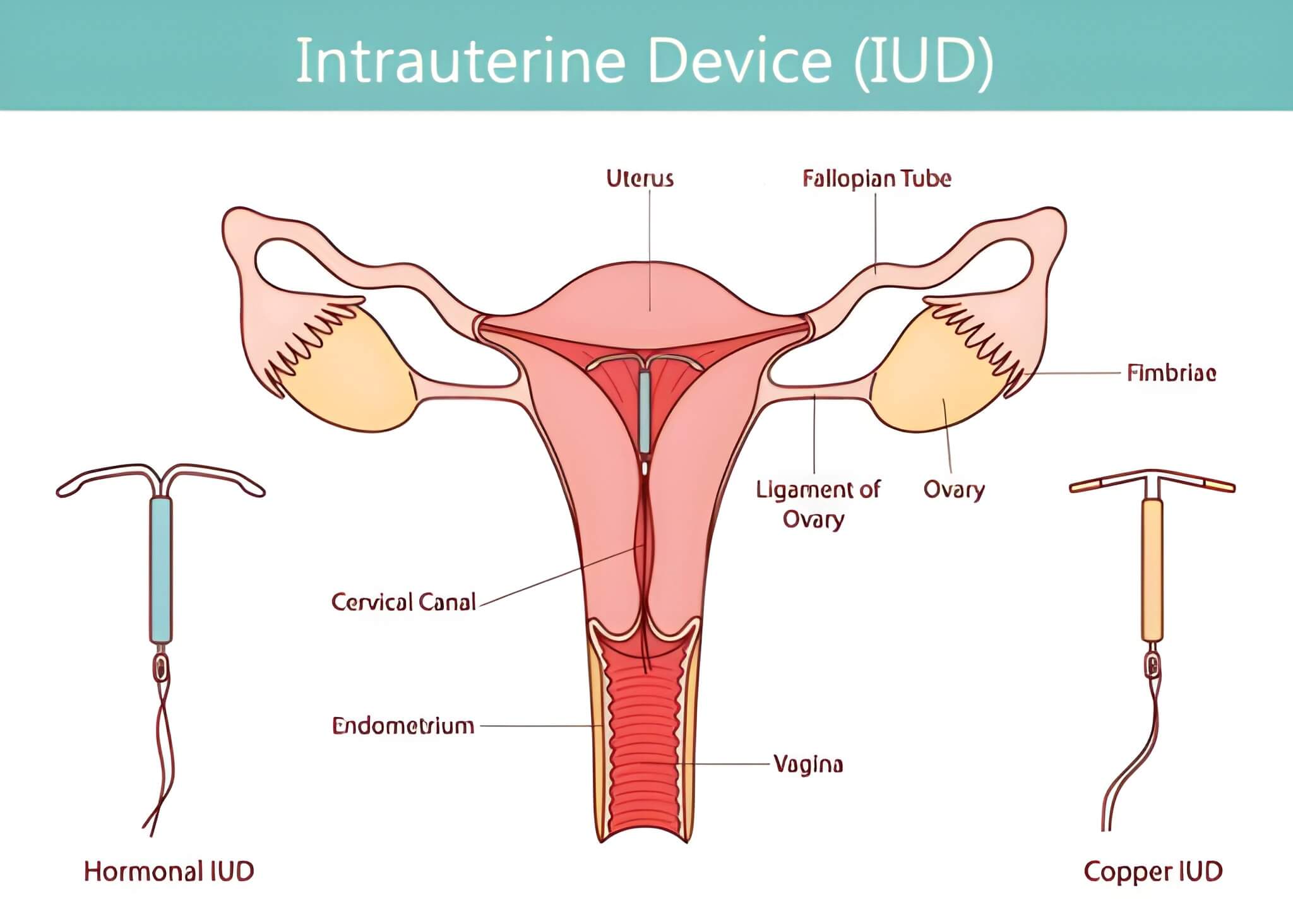 IUD Insertion Diagram